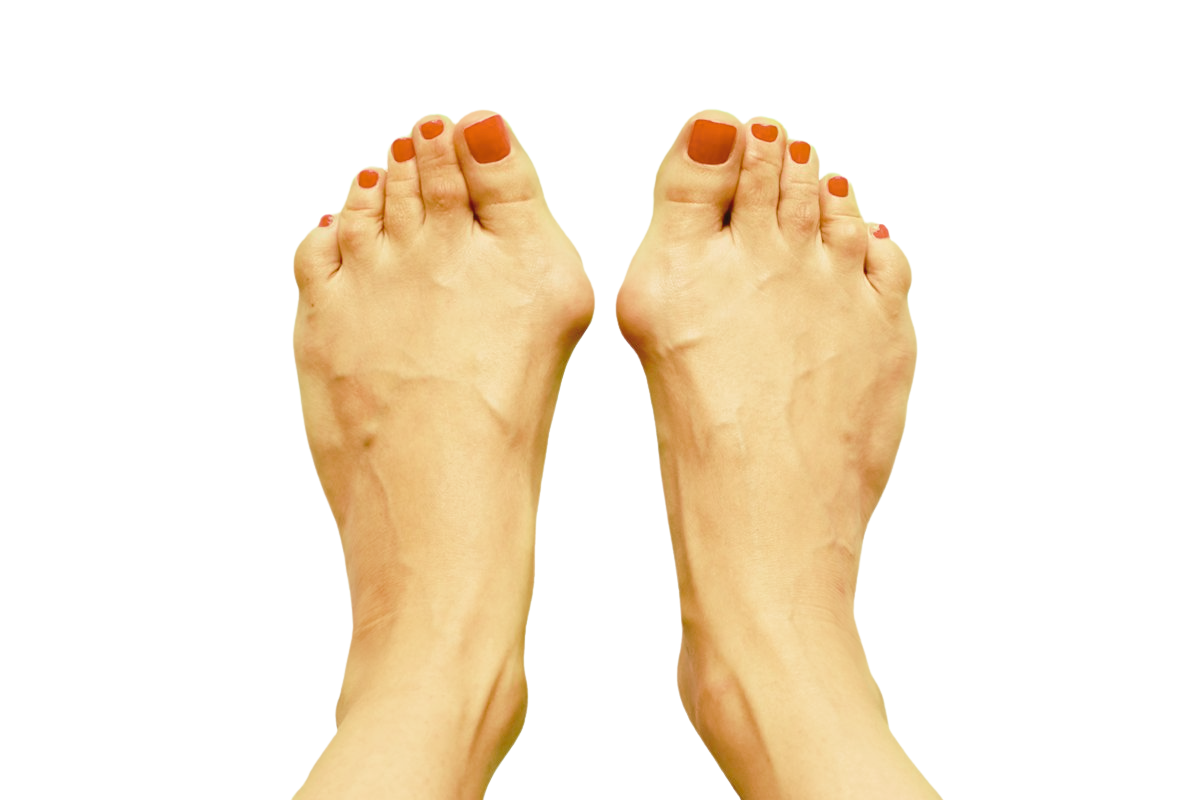 Narbenpflege nach Hallux Valgus Operation